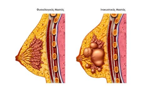 Τι είναι Ινοκυστική μαστοπάθεια;