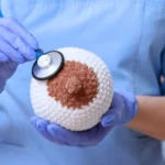 Τι είναι μασταλγία;