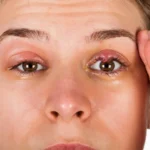 Βλέφαρα: Κόκκινα, Εξογκωμένα και Σακούλες – Αιτίες και Τρόποι Αντιμετώπισης