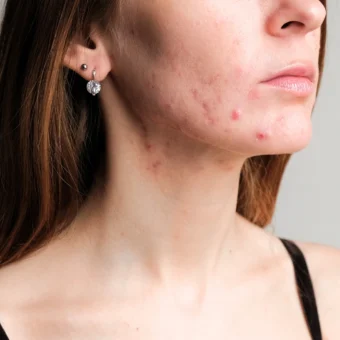 Ακμή ως αποτέλεσμα νευρικής κατάστασης