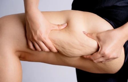 Κυτταρίτιδα σημάδι της κακής υγείας