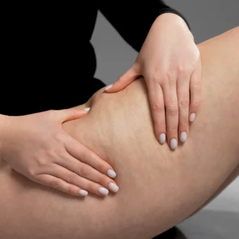 Κυτταρίτιδα